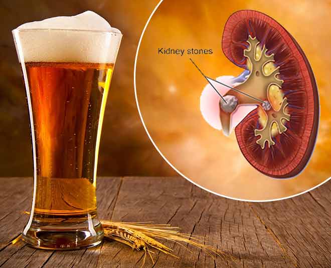 kidney stone beer health Main